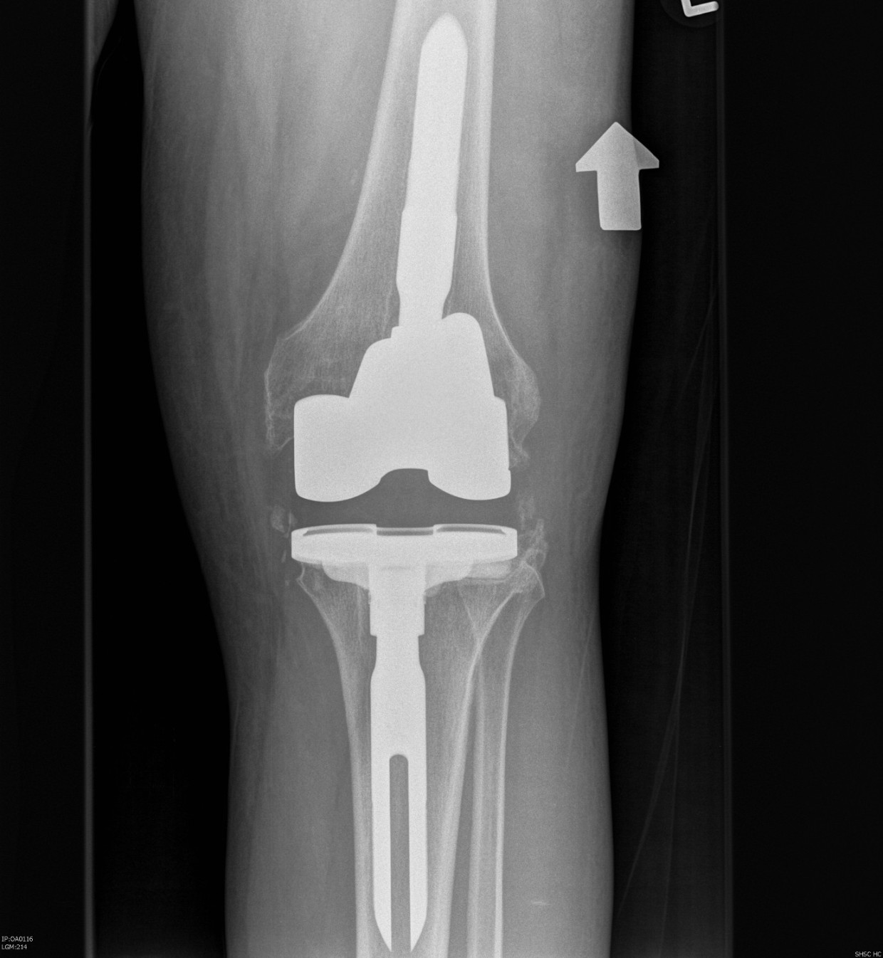 Revision TKR Posterior Stabilisation AP